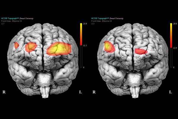 Neurobiologia del Borderline: cosa succede nel cervello di un borderline