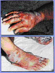 Lesioni della pelle ad opera di armi chimiche