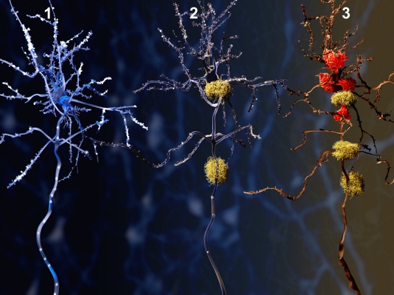 I tre stadi della malattia di Alzheimer: i neuroni soffocati da placche e grovigli vengono poi eliminati e digeriti dalle cellule della microglia, responsabili della difesa immunitaria nel sistema nervoso centrale. | SHUTTERSTOCK