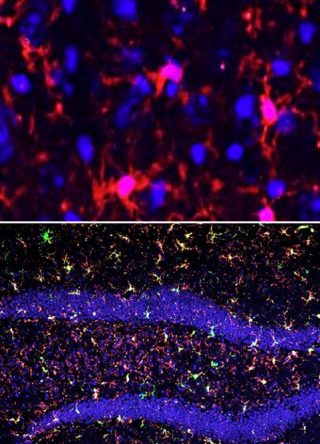 In alto: microglia (in rosso) di topo sana. In basso: microglia attivata (in rosso e verde) nell’ippocampo di un topo irradiato (in entrambe le immagini, in blu sono rappresentati nuclei di cellule per riferimento anatomico). Crediti: Rosi Lab / Ucsf