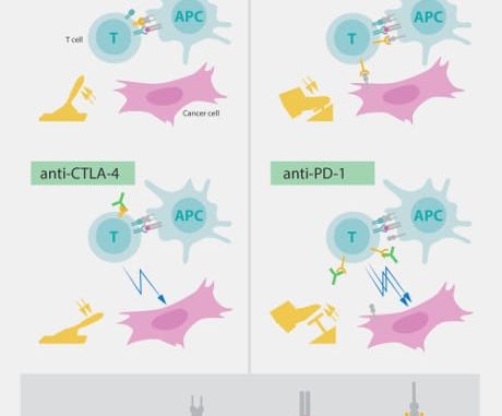 Due vie per riattivare le cellule T. In alto a sinistra: l'attivazione delle cellule T richiede che il recettore delle cellule T si leghi alle strutture di altre cellule immunitarie riconosciute come "non sé". Per l'attivazione delle cellule T è necessaria anche una proteina che funzioni da acceleratore della loro funzionalità. CTLA- 4 agisce come un freno sulle cellule T , imedendo l’azione dell'acceleratore. In basso a sinistra: Gli anticorpi (in verde) contro il CTLA-4 bloccano la funzione del freno, portando all'attivazione delle cellule T, che così attaccano le cellule tumorali. PD-1 è un altro freno che inibisce l'attivazione delle cellule T. In basso a destra: gli anticorpi contro PD-1 inibiscono la funzione del freno, portando all'attivazione delle cellule T e all'attacco altamente efficace sulle cellule tumorali. (© The Nobel Committee for Physiology or Medicine. Illustrator: Mattias Karlén)
