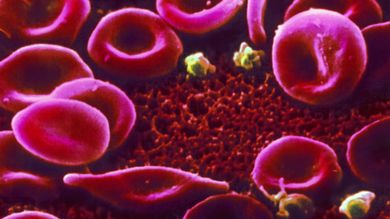 Eritrociti di un paziente con anemia falciforme (© BSIP / AGF)