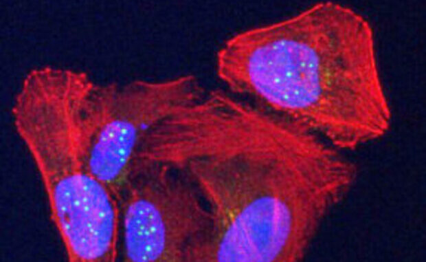 La proteina telomerica VR (sfere verdi) recentemente scoperta si accumula nei nuclei (ovale blu) nelle cellule tumorali dell'osteosarcoma umano colorate in rosso. (Laboratorio Griffith) © ANSA/Ansa