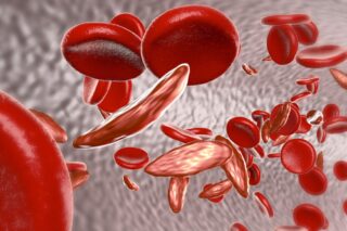 Le malformazioni dell'emoglobina tipiche dell'anemia falciforme: illustrazione medica. Shutterstock